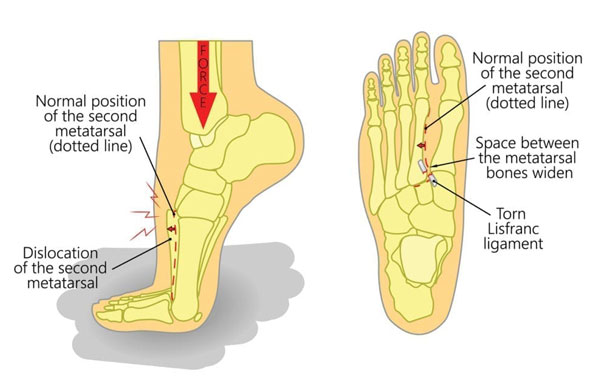 Lisfranc Injuries Management and Treatment - Southwest Foot & Ankle