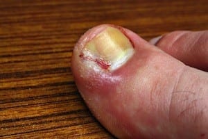 Ingrown toenail