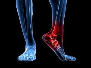 Tarsal tunnel syndrome